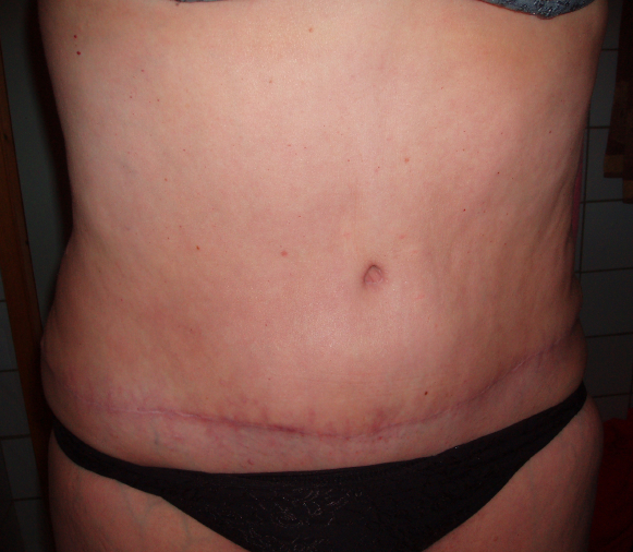 gravid etter bukplastikk gravid etter bukplastikk